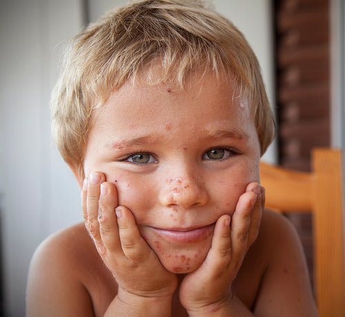 Un niño de menos de un año con un brote de eccema en la cara - Mustela España - 1