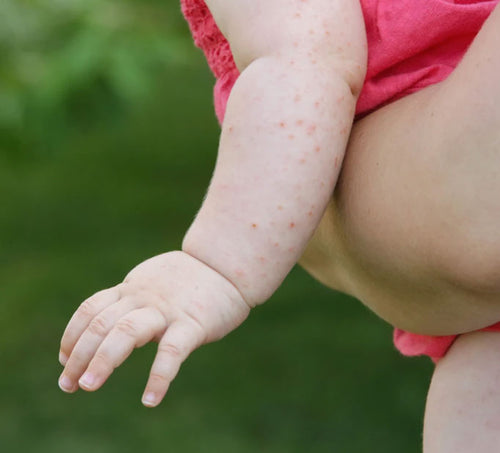 Brote de dermatitis atópica en el brazo de un bebé. - Mustela España - 1